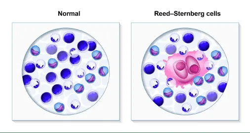 Lymphoma symptoms and warning signs infographic with swollen lymph nodes fatigue fever and unexplained weight loss indicators